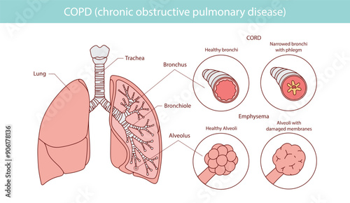 COPD infographic: manifests itself in two forms emphysema and bronchitis