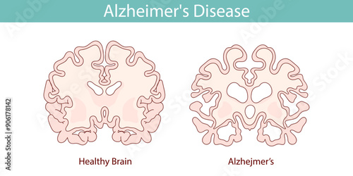 Healthy brain and brain with Alzheimer's disease. Hand drawn illustration.