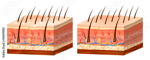 Seborrhoeic or Seborrheic dermatitis. Before and after treatment. Chronic or relapsing form of dermatitis that mainly affects the scalp