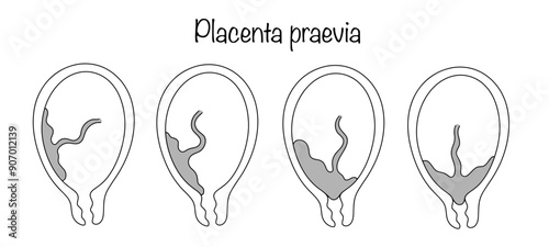 Placenta praevia