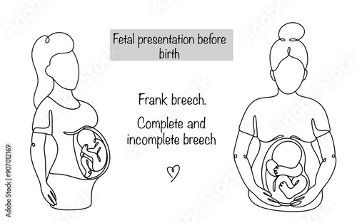 Frank breech