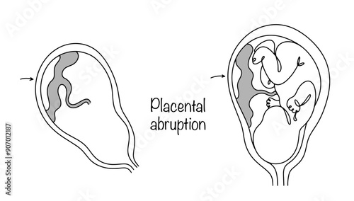 Placental abruption