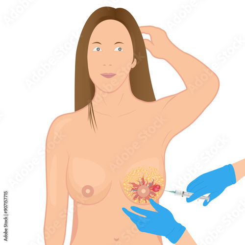 Breast cancer diagnostic biopsy to obtain a sample by an experienced physician in a medical clinic