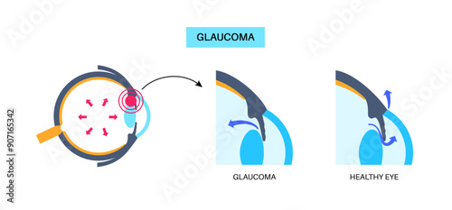 Glaucoma eye disease