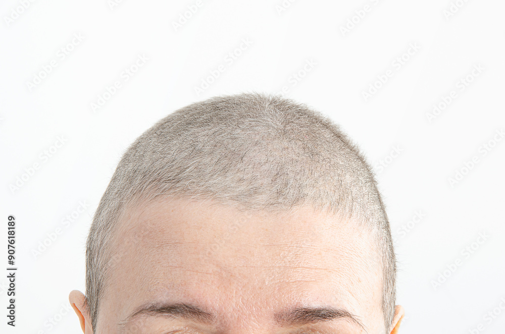 Fototapeta premium Regrowth Journey: 62-Year-Old Woman's Hair Begins to Return 70 Days Post-Chemotherapy, Captured in Close-Up Photo.