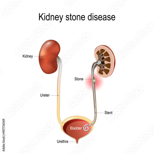 Kidney stone disease. Cross section of Ureter with Stone and Stent