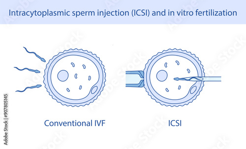 Intracytoplasmic sperm injection (ICSI) and in vitro fertilization hand drawn in line style