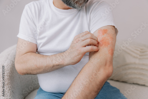 Close up shot of senior fat man scratching forearm sitting on living room at home. Allergy symptom. Copy space