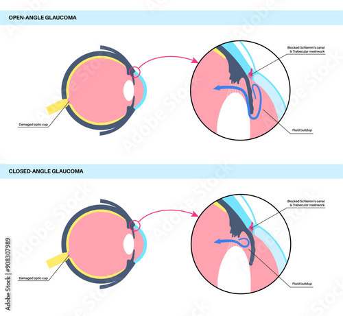 Glaucoma eye disease