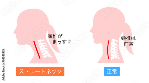 正常とストレートネックの女性の頸椎の比較説明イラスト