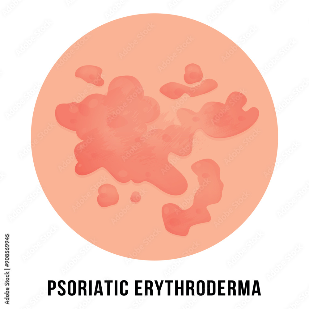 Psoriatic erythroderma in the form of large red spots on a white background Psoriatic erythroderma in the form of large red spots on a white background