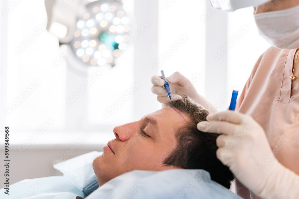 Closeup side view of unrecognizable female nurse drawing using pencil new hairline on head of patient male before hair transplantation surgery in clinic. Concept of professional baldness treatment. Closeup side view of unrecognizable female nurse drawing using pencil new hairline on head of patient male before hair transplantation surgery in clinic. Concept of professional baldness treatment.