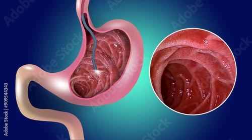2D animation. Gastric mucosa. Digestive endoscopy or gastroscopy. Performing a gastroscopy procedure. Diagnostics of gastric diseases. Stomach health. Medical concept
