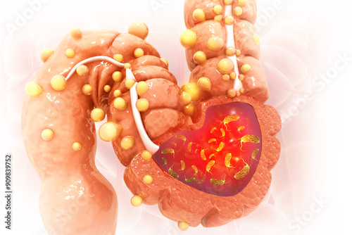 Foto Visual concept of Bacterial infection of the colon, colon cancer