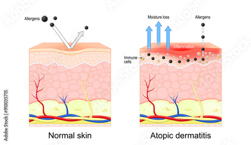 Atopic dermatitis. Eczema photo