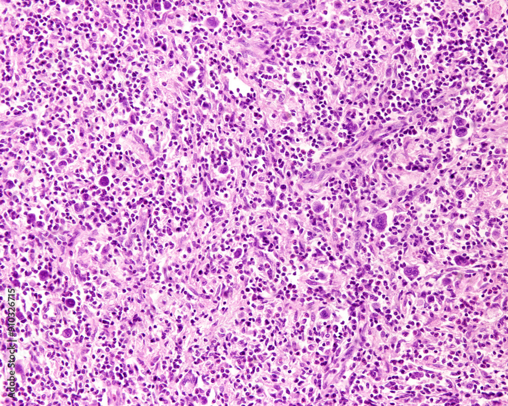 Lymph node. Hodgkin lymphoma Lymph node. Hodgkin lymphoma
