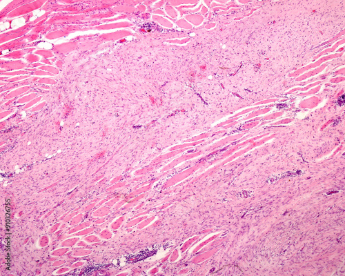 Muscle fibrosarcoma photo