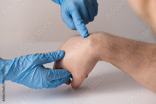 Bild auf Leinwand Ganglion cyst or hygroma of the wrist on the hand of a male patient, examination