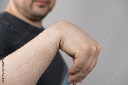 A male patient shows a ganglion cyst on his wrist. photo