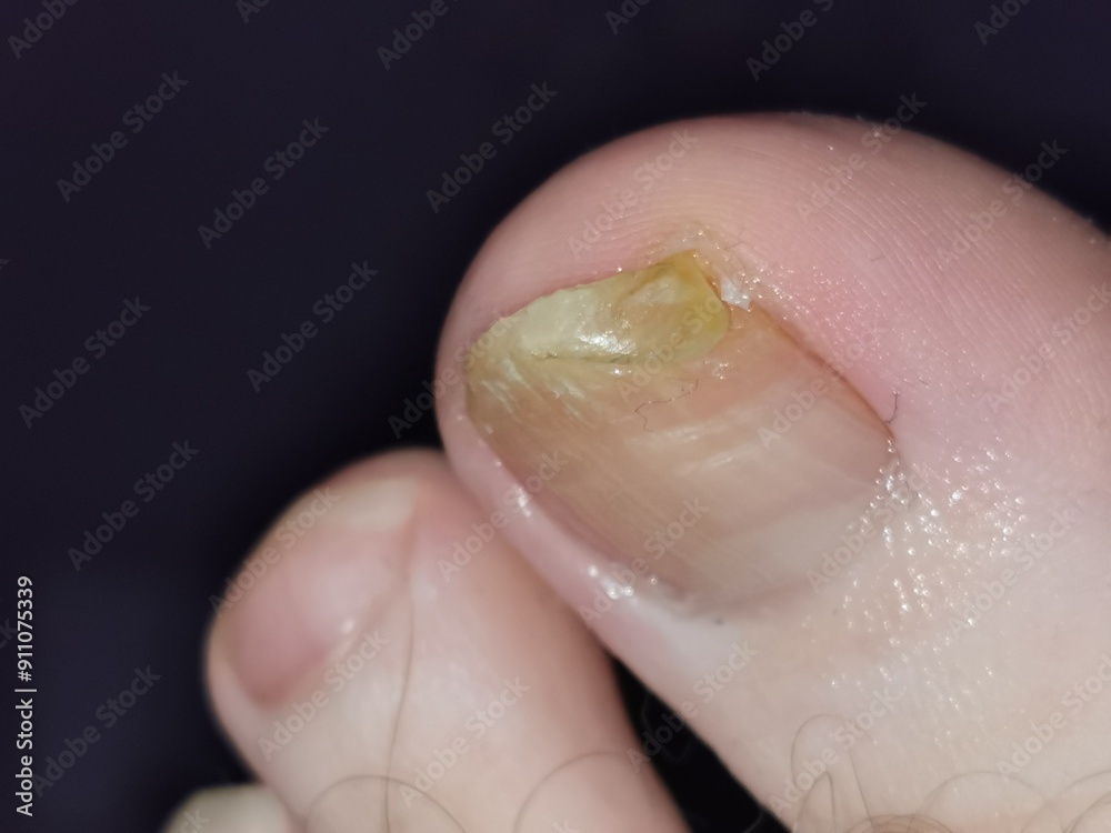 Fototapeta premium nail fungus on the leg finger