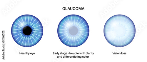 Glaucoma eye disease