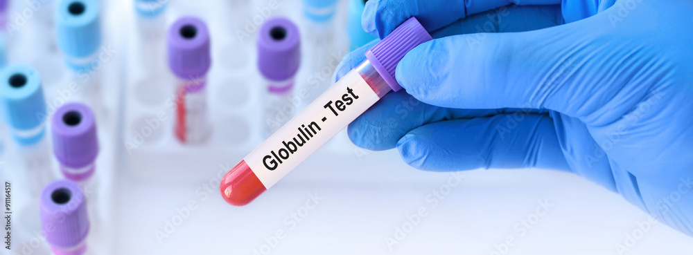 Naklejka premium Doctor holding a test blood sample tube with Globulin test on the background of medical test tubes with analyzes.