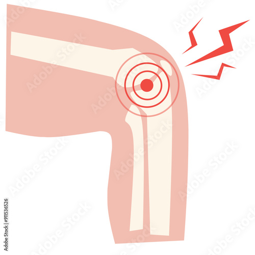 Rheumatoid arthritis knee joint pain Illustration 