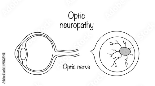 Optic atrophy