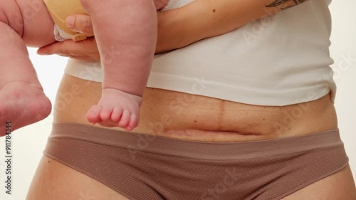Woman belly with a scar from cesarean section with newborn baby's legs. Dolly shot of the abdomen with c-section scar. Cropped view of a mother holding baby showing a real body. Postpartum recovery.