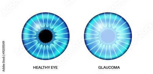 Glaucoma eye disease