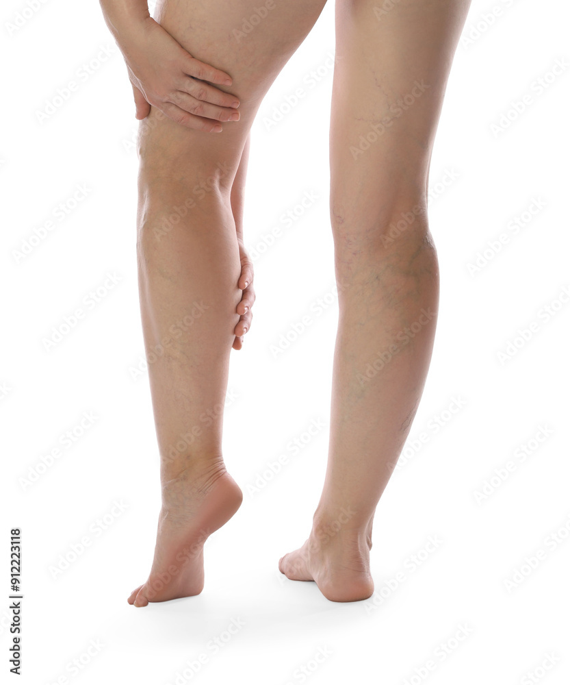 Woman suffering from varicose veins on white background, closeup Woman suffering from varicose veins on white background, closeup