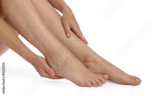 Woman suffering from varicose veins on white background, closeup