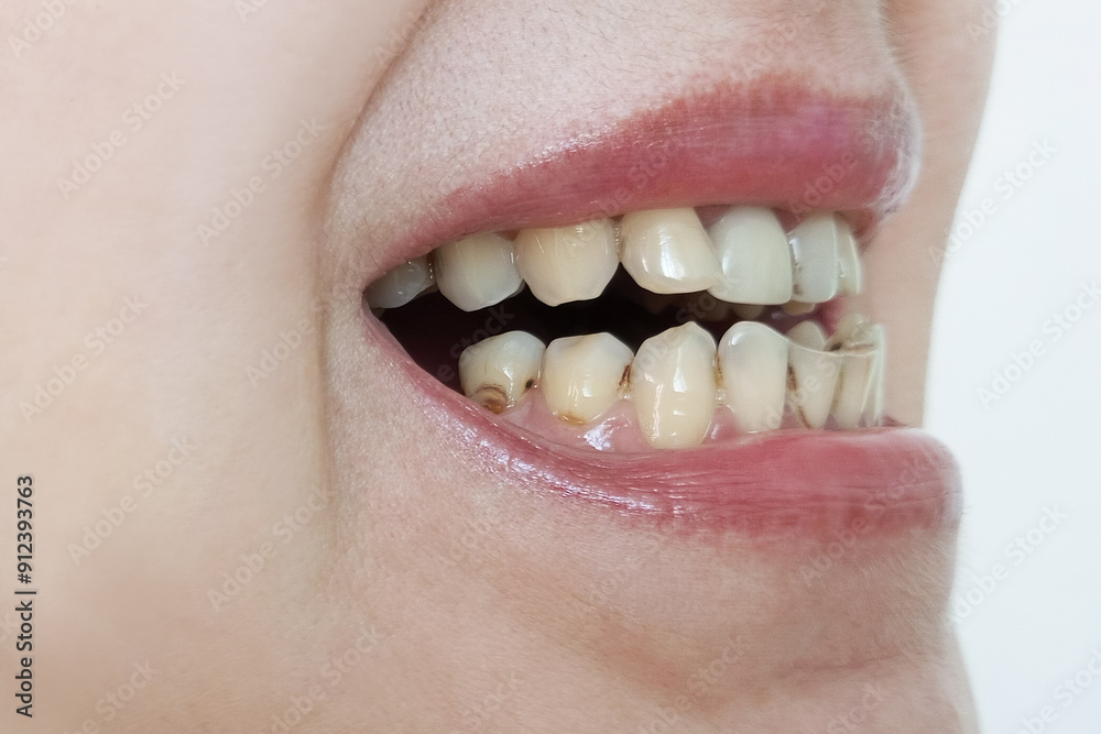 Fototapeta premium Caries and plaque. Open mouth close-up.