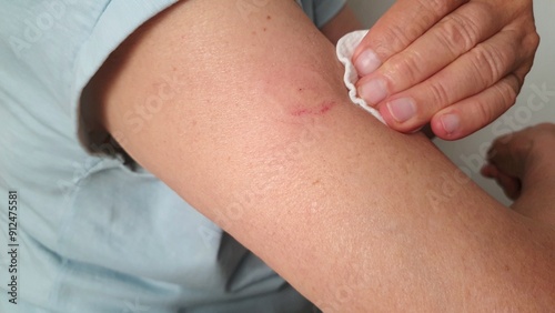 Stage 2. Disinfection of a wound after removing the non-contact glucose meter from the arm to quickly measure blood glucose levels. Non-contact shoulder glucometer for diabetics. Device for diabetics