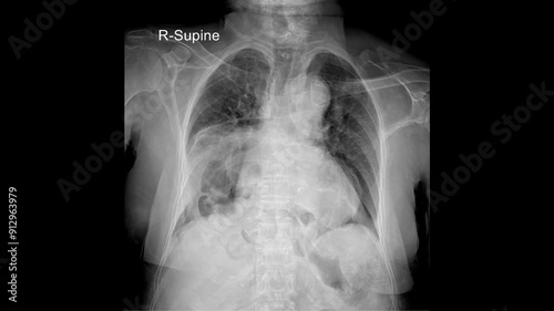 Diagnostic PA Chest X-ray: Comprehensive Assessment of Thoracic Health and Respiratory Conditions