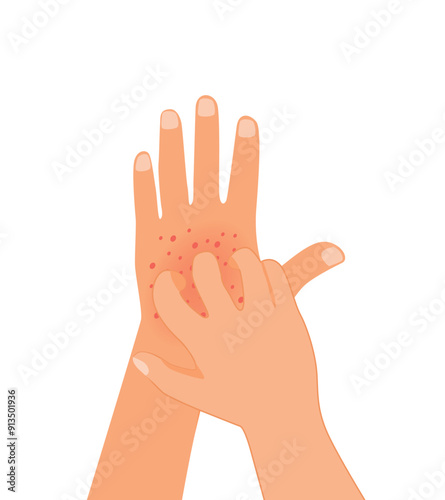 hand scratching itchy hand with allergic rash skin