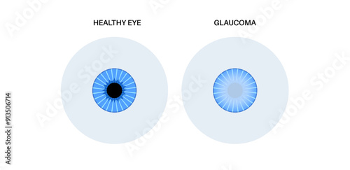 Glaucoma eye disease