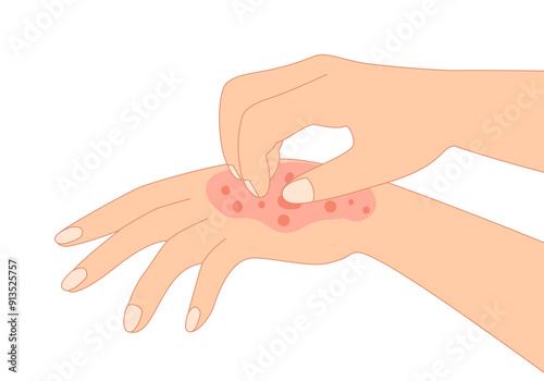 Rash skin on hand. Scratching arm in red spot, dermatitis allergy symptom skin disease.