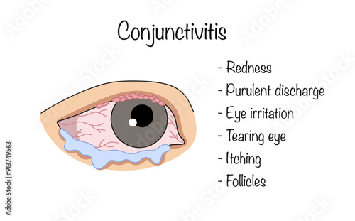 Conjunctivitis