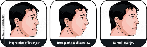 Deformities of mandibular with normal jaw, prognathism and petrognathia