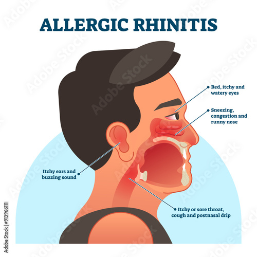 Allergic rhinitis medical diagram, illustration labeled information, transparent background. Patient symptoms like red, itchy eyes, sneezing and runny nose, sore throat and buzzing sound in ears.