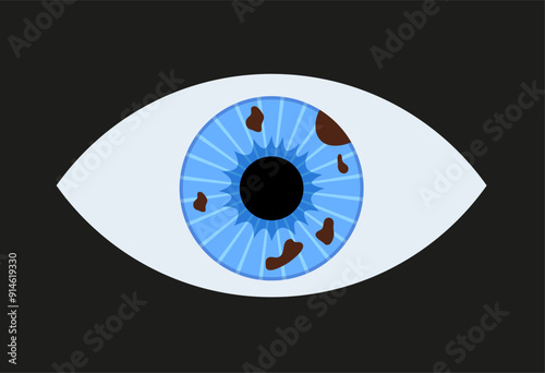 Iris melanoma anatomy