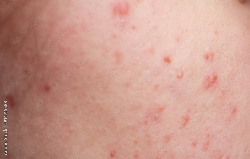 Fototapeta premium Skin texture background. Closeup acne pimple. Treatment for skin. Problem skincare. Pimples, acne, pores, scars. Natural skin. Skin care concept. Acne treatment. Pimples on face. Acne and pimple on