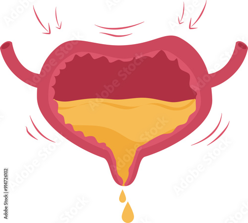Urinary bladder disease.Overactive bladder Illustration.