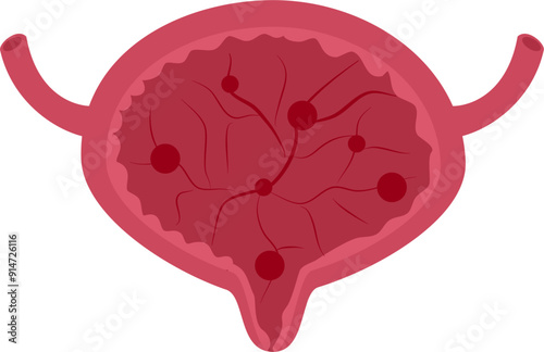 Urinary bladder disease. Cystitis bladder Illustration.