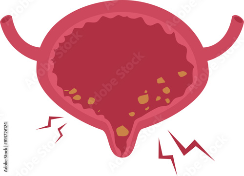 Urinary bladder disease.Bladder stones Illustration.