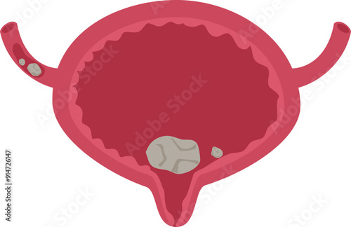 Urinary bladder disease.Bladder stones Illustration.
