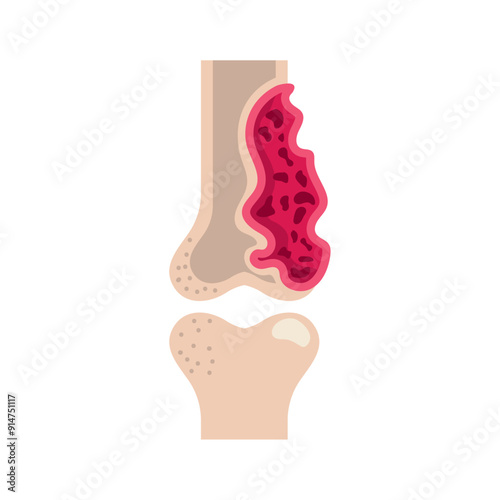 multiple myeloma bone marrow cancer