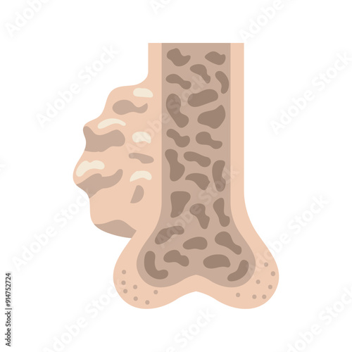 multiple myeloma cross section of bones