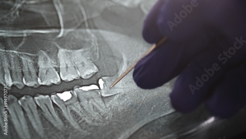 Photos Panoramic Xray tooths showing Amalgam that used for dental  restorative material